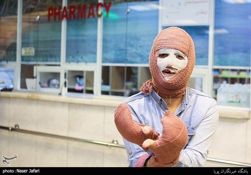 شیوع سوختگی در ایران ۸برابر جهان/راهکارهای پیشگیری از سوختگی