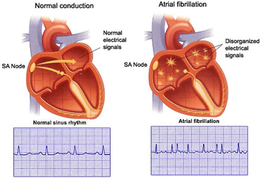 مکانیزم شروع فیبریلاسیون دهلیزی: داستان یک چالش الکتروکاردیوگرافی (ECG)