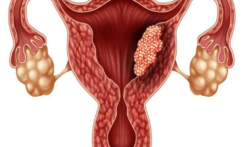 نتایج استراتژی‌های پیشگیری از سرطان آندومتر در بیماران مبتلا به سندرم لینچ: یک مطالعه کوهورت سراسری در هلند