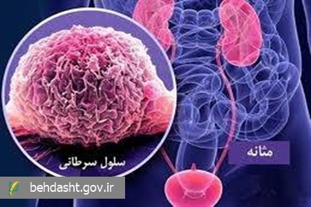 آگاهی و اقدام به‌موقع؛ کلید موفقیت در درمان سرطان مثانه