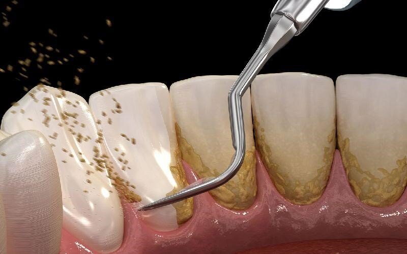 آیا جرم گیری دندان ضرر دارد؟ بررسی عوارض احتمالی جرم گیری