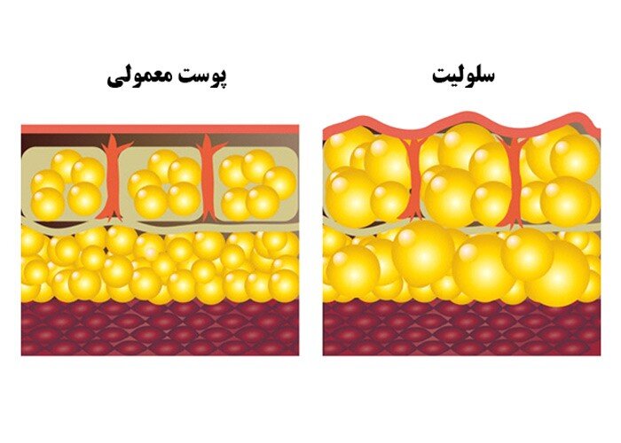 آیا سلولیت در خانه قابل درمان است؟ بهترین روش درمان سلولیت در منزل