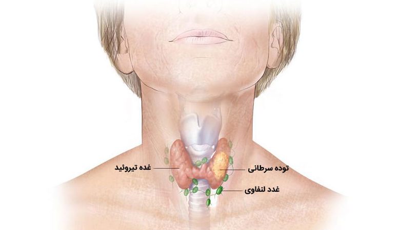 تیروئیدکتومی بدون ید رادیواکتیو در بیماران مبتلا به سرطان تیروئید کم‌خطر