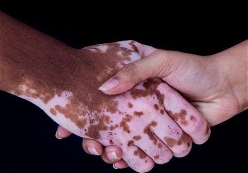 لک‌ های پوستی