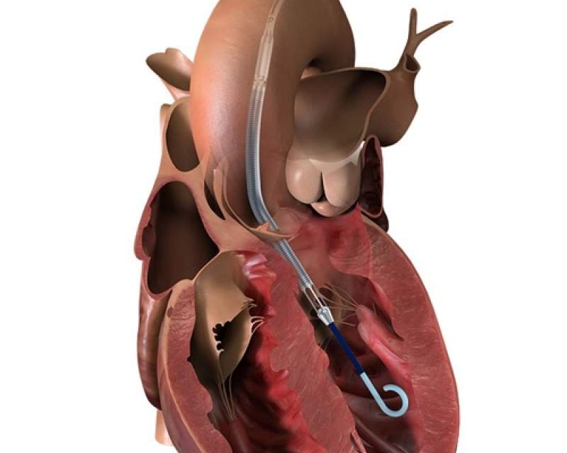 پمپ قلبی Impella