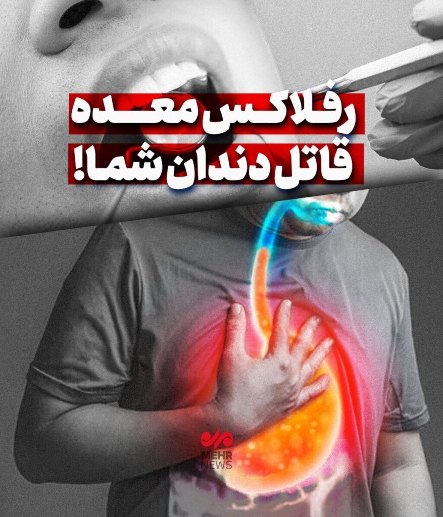 رفلاکس معده