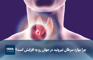 سرطان تیروئید